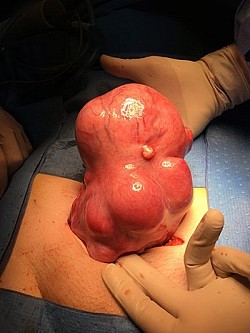 fibroids natural cure